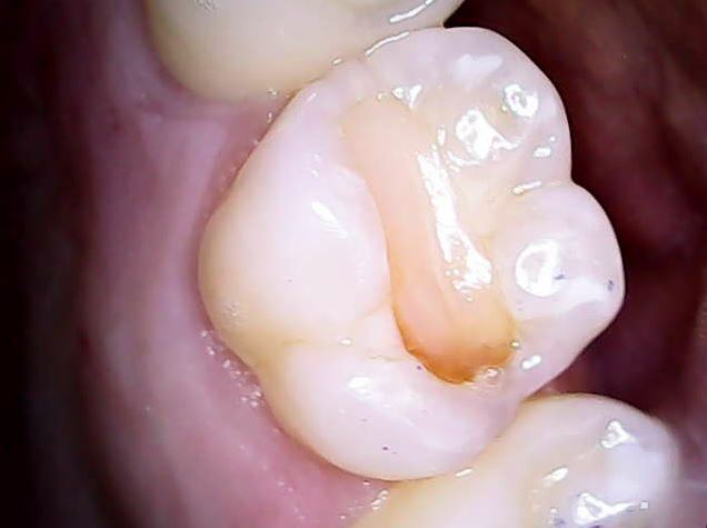 resina dental con filtracion, resina dental vieja