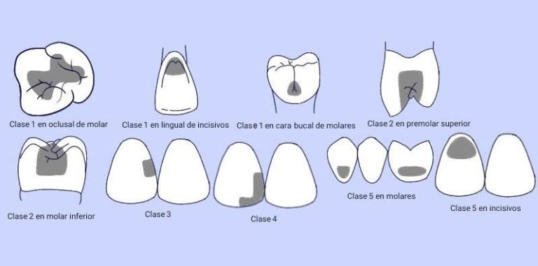 Clasificación De Las Cavidades Dentales Propuesta Por Gv Black 9782