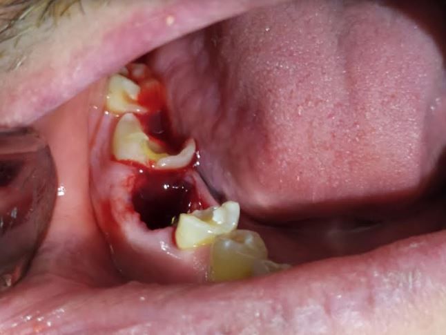 hemorragia dental, extraccion dental, fractura dental, hr-dental