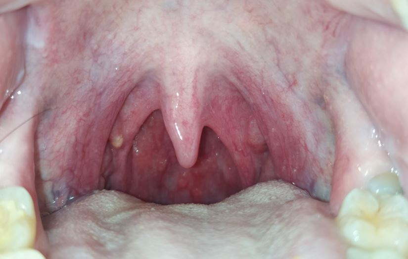 faringitis hr-dental-imagen de hr-dental