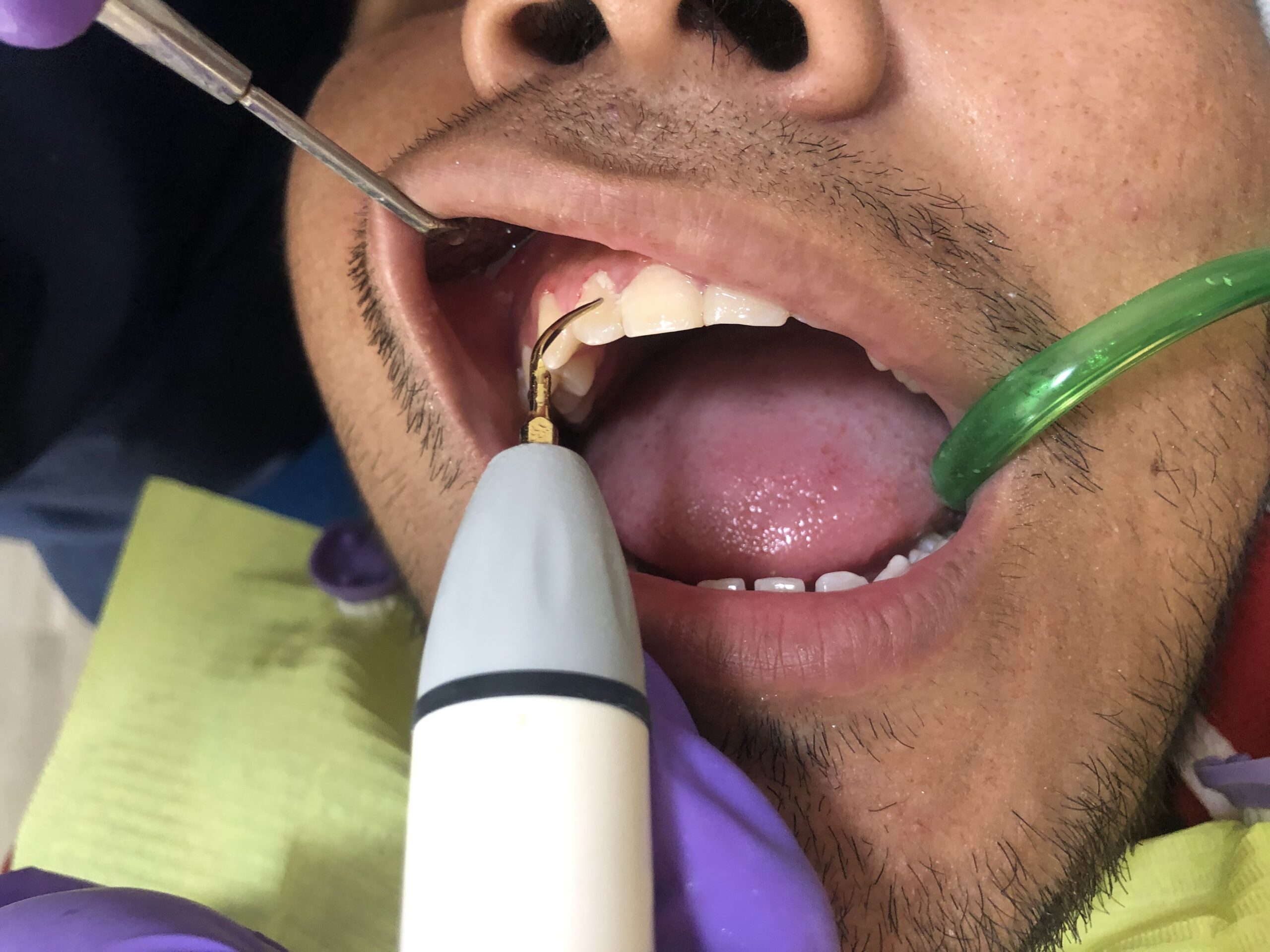 limpieza dental con escariador-hr-dental